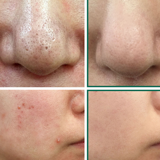Miracle Cleansing Bar by Some By Mi